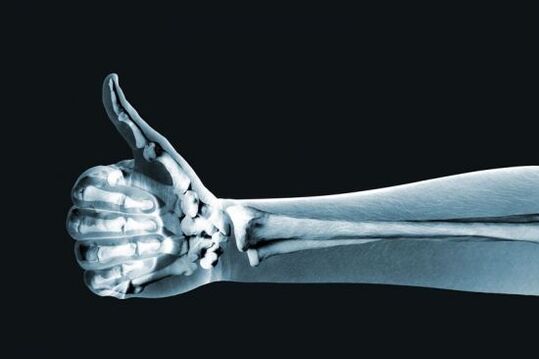 X-ray diagnosis of finger joint pain