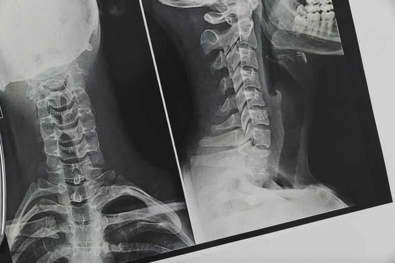 X-rays of the cervical spine affected by osteochondrosis