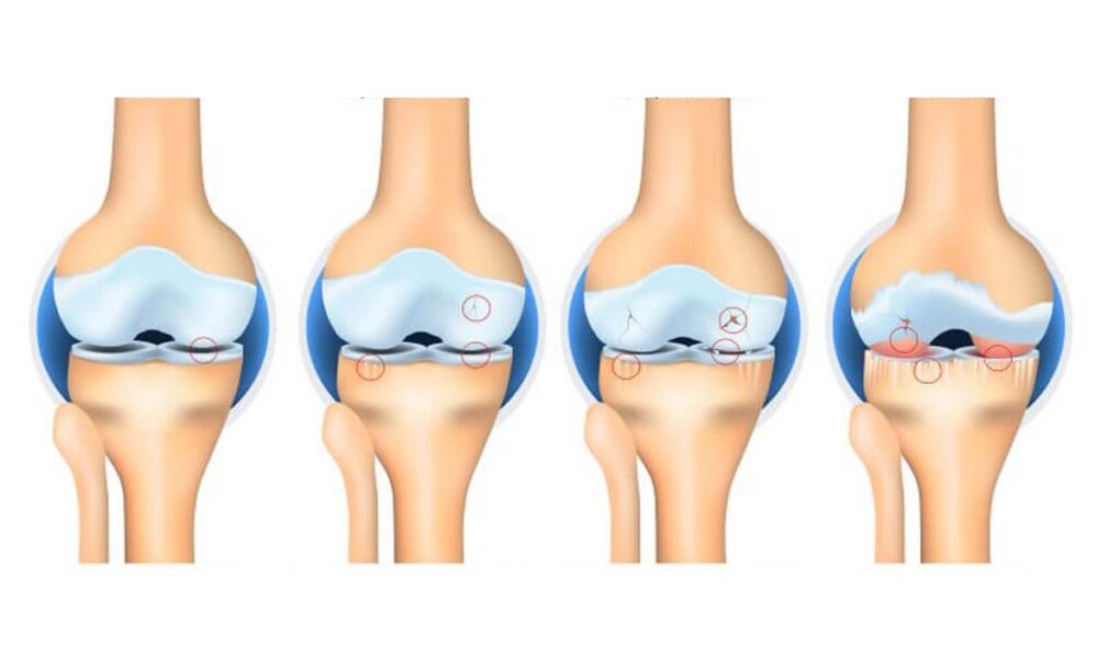 Stages of knee arthropathy