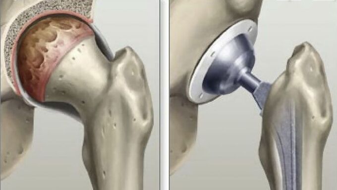 Hip replacement surgery in the final stages of hip arthrosis