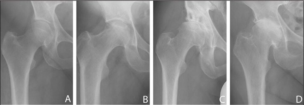 Stages of development of hip arthritis on X-ray