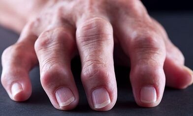 What is the difference between arthritis