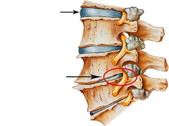 Diseases of intervertebral discs