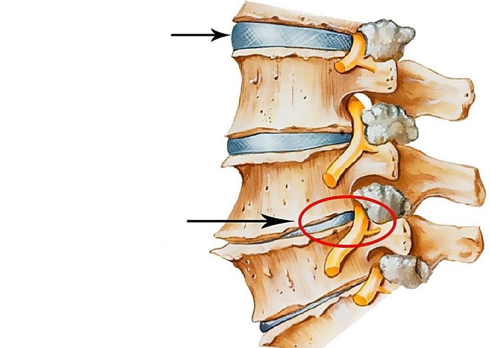 Healthy and deformed intervertebral disc illustration