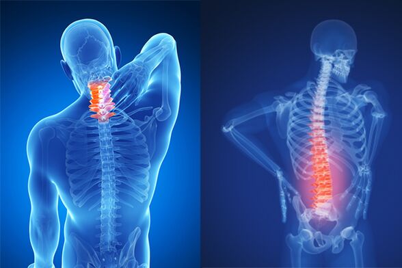 Cervical and lumbar osteochondrosis