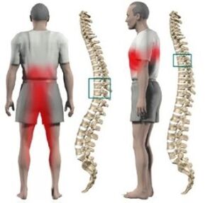 Spinal herniation