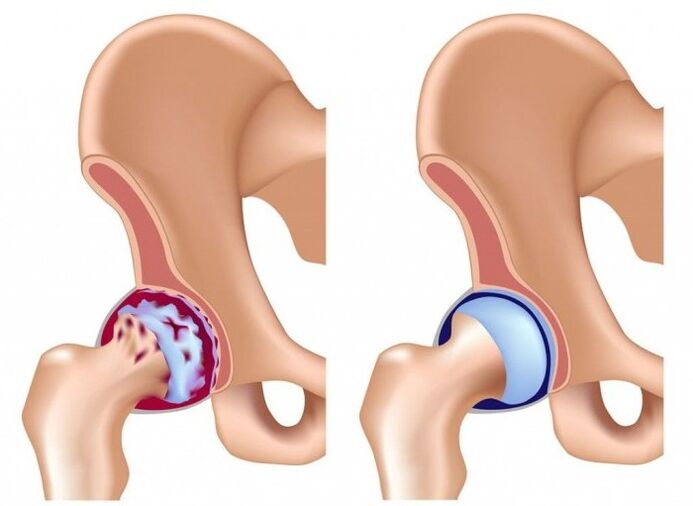 hip injuries caused by joint