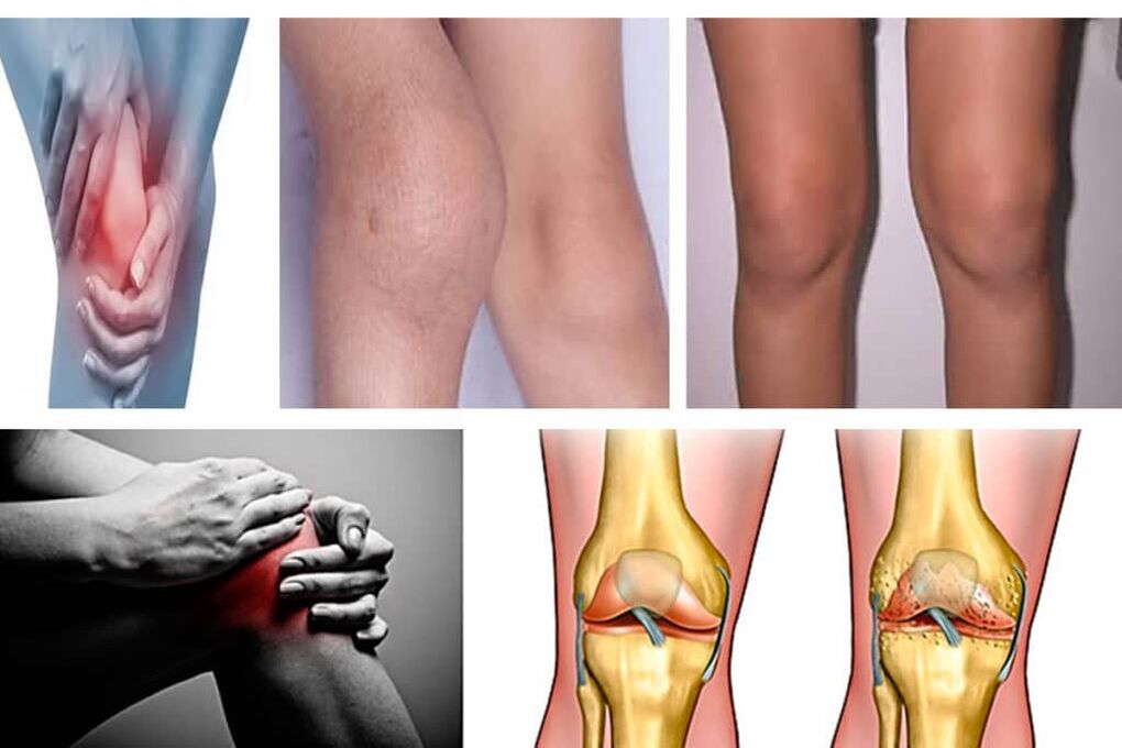 What is joint disease