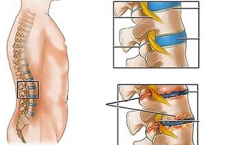Causes of lumbar vertebrae