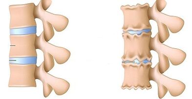 How to identify the existence of lumbar vertebrae