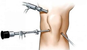 Arthroscopy for knee joint disease